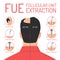 FUE follicular unit extraction procedure vector isolated