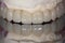 A full arch dental implant bridge with mirror reflection