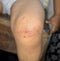 Fungal infection called tinea corporis in leg. Widespread ringworm over knee area
