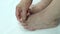 Fungal infection on nails of person`s foot