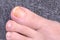 Fungal nail damage.Sore Toes on a dark gray background.Ð¡lose up.Soft focus.Concept of infection and treatment of the fungus of