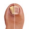 Fungal Nail Infection