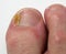 Fungal Nail Infection on big toe