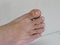 Fungal Nail Infection Onychomycosis Tinea Unguium