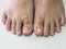 Fungal Nail Infection Onychomycosis Tinea Unguium