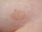 Fungal skin rash infection mark. Close up of patch.