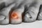 Fungus Infection on Nails of male Feet