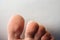 Fungus Infection on Nails of Man\'s Foot on white background