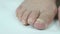 Fungus infection nails of person`s foot