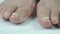 Fungus infection on toenails of female\'s foot