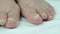 Fungus infection on toenails of female\'s foot
