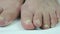 Fungus infection on toenails of female`s foot