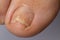 Fungus of nails on the big toe - dermatomycosis and onychomycosis, fungal infection macro photo. Ingrown nail plate. Dermatology,