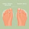 Fungus toenail infection vector medicine card. Colorful design. Detailed image with text.