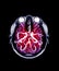 Fusion image of MRI brain and MRA Brain.