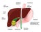 Gallstones