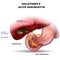 Gallstones and acute pancreatitis