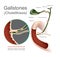 Gallstones cholelithiasis