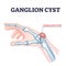 Ganglion cyst as tendon fluid filled swelling near arm joint outline diagram