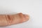 Ganglion Cyst on finger