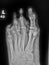 Gangrenous left foot in diabetic patient - soft tissue gas on Xray