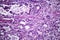 Gastric adenocarcinoma, light micrograph