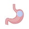 Gastric Balloon Stomach