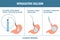 Gastric balloon weight loss procedure phases shown in stomach