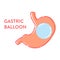 Gastric balloon weight loss procedure shown in stomach
