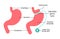 Gastric Band anatomical medical illustration diagram. Surgery divide stomach into two parts with band. Human stomach anatomy