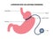 Gastric band poster