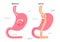Gastric Bypass / stomach anatomy