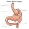 Gastric bypass surgery diagram medical science