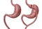 Gastric bypass is a type of bariatric surgery that consists of reducing the stomach and altering the bowel, leading to a marked