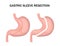 Gastric sleeve resection infographic. Stomach reduction surgery for weight loss. Medicine concept. Vector illustration