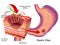 Gastric ulcer