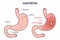 Gastritis as stomach lining inflammation illness and disease outline diagram