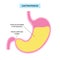 Gastroparesis anatomical poster