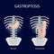 Gastroptosis stomach. The omission of the stomach. Stage gastroptosis. Vector illustration