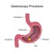 Gastroscopy Procedure Diagram