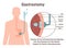 Gastrostomy. Gastric inserted feeding tube, food nutritions injecting