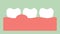 Gingivitis or gum disease, gum inflammation before periodontal disease