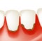 Gingivitis. Inflammation of the gums. Dental calculus. Infographics. Vector illustration on isolated background