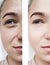 girl beauty wrinkles eyes before and after cosmetology procedures