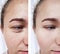 girl beauty wrinkles eyes before and after procedures
