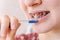 The girl cleans the remains of food from the braces with a special brush for interdental spaces