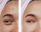 Girl eye treatment closeup , removal health before and after procedures, therapy acne