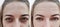 Girl face wrinkles acne removal swelling before and after procedures, skin