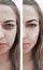 Girl face wrinkles patient acne removal swelling before and after procedures, skin
