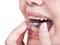 Girl fixes aligner for orthodontic correction